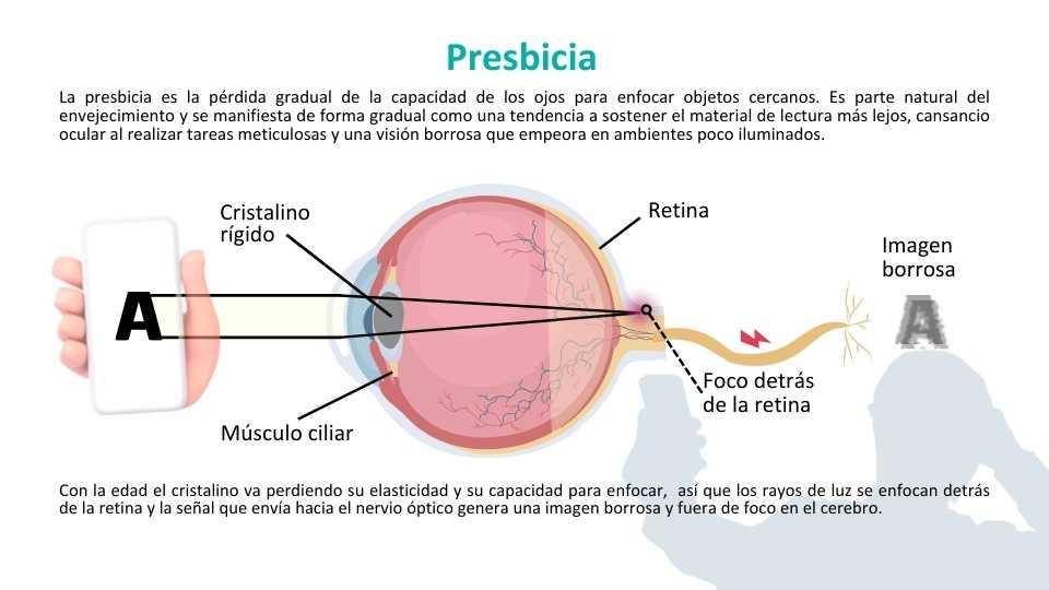 PRESBICIA Hospital Ruber Internacional